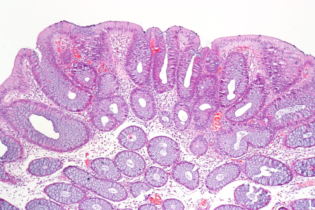 Tubular adenoma