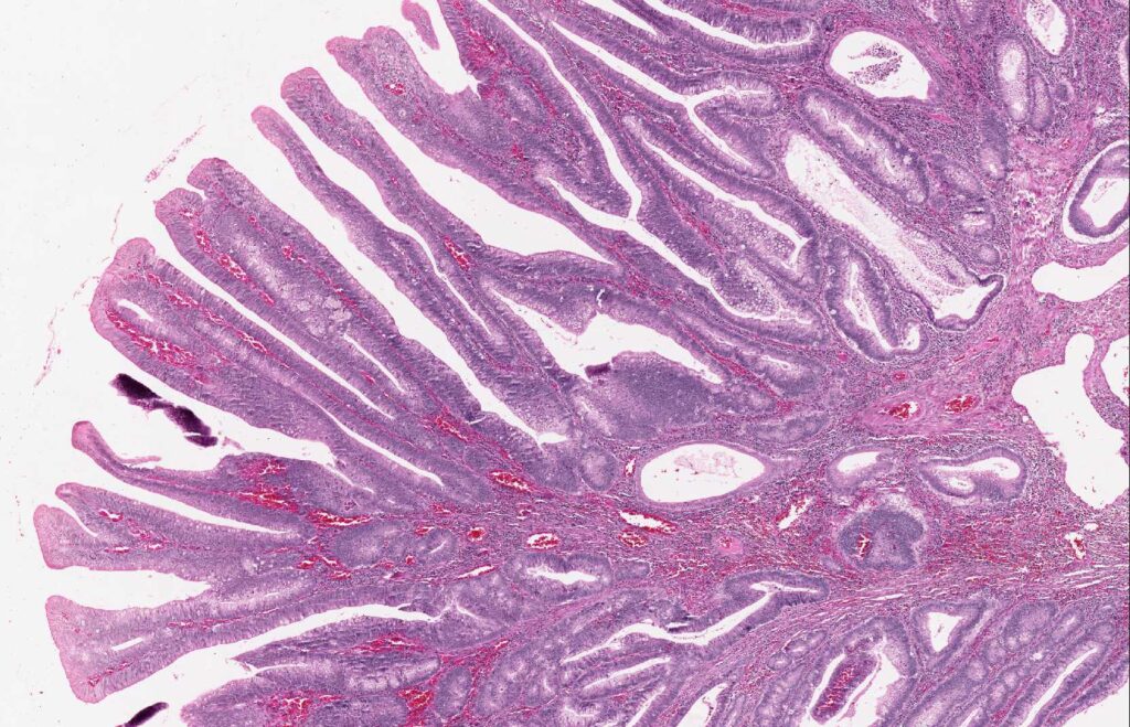 Villous adenoma