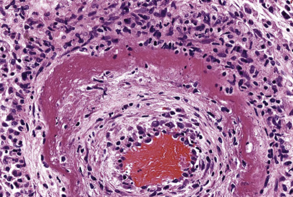 Noncaseating Necrosis The Morphology of Necrosis: Understanding the Patterns of Cell Death